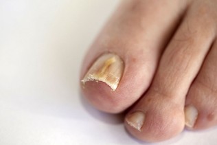 halamang-singaw ng toenails