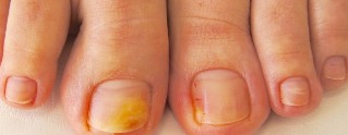 halamang-singaw toenails sintomas
